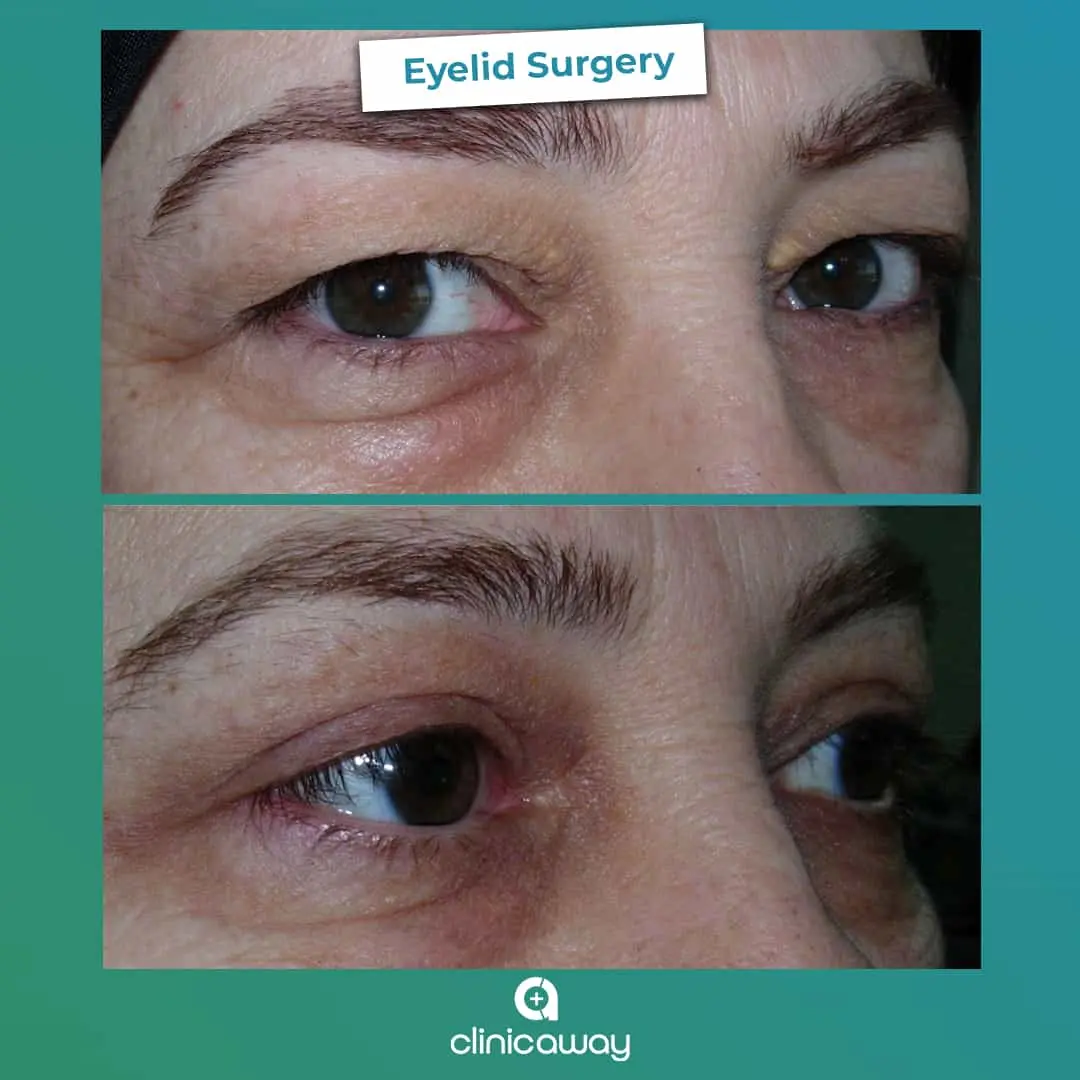 7-eyelid surgery.webp